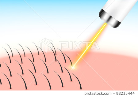 Yellow laser light hair removal unwanted out make skin smooth. Medical beauty concept. 3D Realistic vector EPS10. 98233444