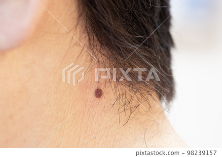 男人脖子上長痣 98239157