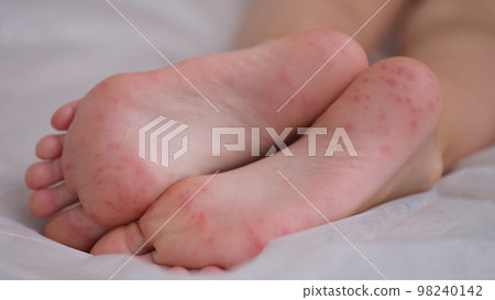 Eczema is an irritation caused by an allergic lesion of skin of feet in child Eczema is an irritation caused by an allergic lesion of skin of feet in child 98240142