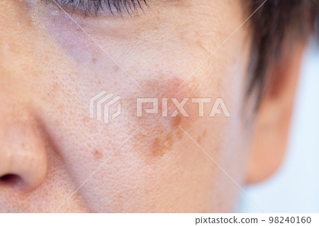 男性臉頰老年斑 98240160