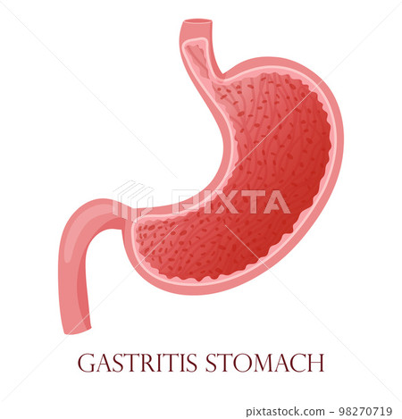 Gastritis mucosa cells inflammation illustration 98270719