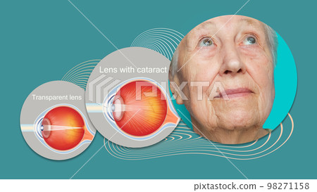 Cataract concept. Senior woman's eye, closeup Cataract concept. Senior woman's eye, closeup 98271158