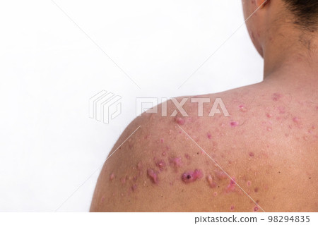 occipital acne in a teenage boy healed, scars from teenage acne on the shoulders, skin infections and allergies to the body of a man, healthcare and medical concept occipital acne in a teenage boy healed, scars from teenage acne on the shoulders, skin infections and allergies to the body of a man, healthcare and medical concept 98294835