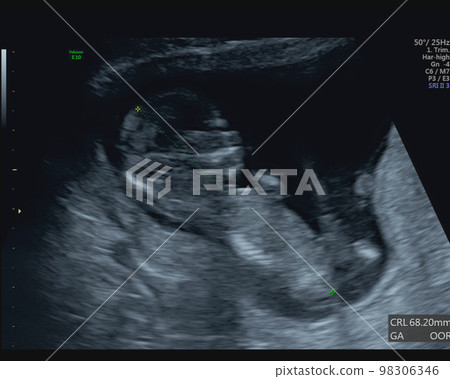 Ultrasound photo of a fetus at 13 weeks of gestation Ultrasound photo of a fetus at 13 weeks of gestation 98306346