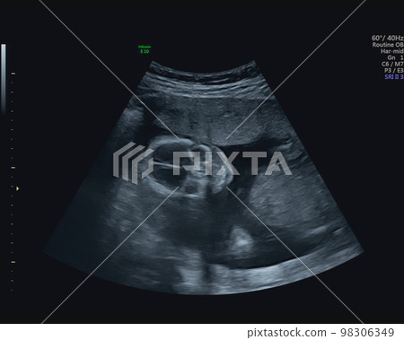 孕17週胎兒超聲照片 孕17週胎兒超聲照片 98306349