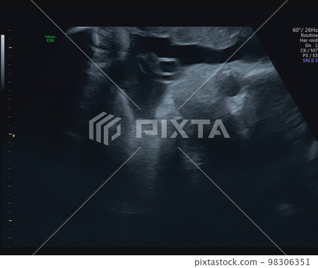 孕33週胎兒超聲照片 孕33週胎兒超聲照片 98306351