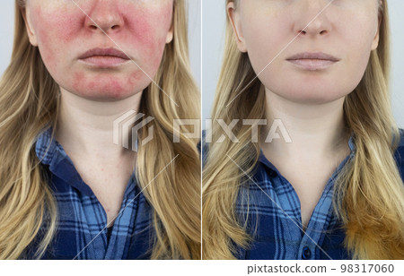 Rosacea face. The girl suffers from redness on her cheeks. Couperosis of the skin. Redness and capillary mesh are visible on the face. Treatment and removal. Vascular surgery and dermatology Rosacea face. The girl suffers from redness on her cheeks. Couperosis of the skin. Redness and capillary mesh are visible on the face. Treatment and removal. Vascular surgery and dermatology 98317060