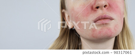Rosacea face. The girl suffers from redness on her cheeks. Couperosis of the skin. Redness and capillary mesh are visible on the face. Treatment and removal. Vascular surgery and dermatology 98317061