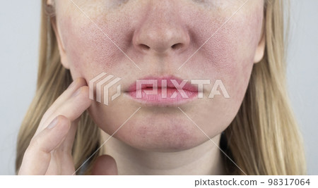 Enlarged pores. Close-up of skin with large pores. Dermatology and cosmetology. Treatment of problems associated with oily skin. Couperose and rosacea Enlarged pores. Close-up of skin with large pores. Dermatology and cosmetology. Treatment of problems associated with oily skin. Couperose and rosacea 98317064