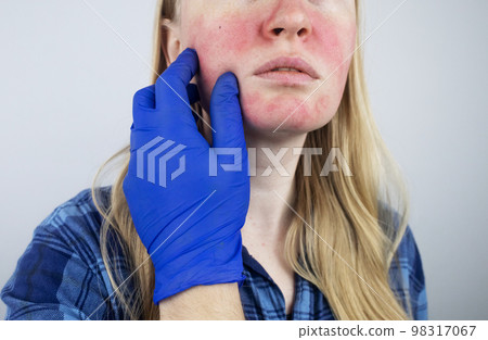 Rosacea face. The girl suffers from redness on her cheeks. Couperosis of the skin. Redness and capillary mesh are visible on the face. Treatment and removal. Vascular surgery and dermatology Rosacea face. The girl suffers from redness on her cheeks. Couperosis of the skin. Redness and capillary mesh are visible on the face. Treatment and removal. Vascular surgery and dermatology 98317067