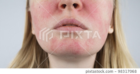 Rosacea face. The girl suffers from redness on her cheeks. Couperosis of the skin. Redness and capillary mesh are visible on the face. Treatment and removal. Vascular surgery and dermatology Rosacea face. The girl suffers from redness on her cheeks. Couperosis of the skin. Redness and capillary mesh are visible on the face. Treatment and removal. Vascular surgery and dermatology 98317068