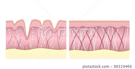 Collagen and elastin fibers in young and wrinkled skin comparison. The medical illustrations show results after anti-aging therapy or collagen-boosting cream. Comparison of age and young human skin. 98319468