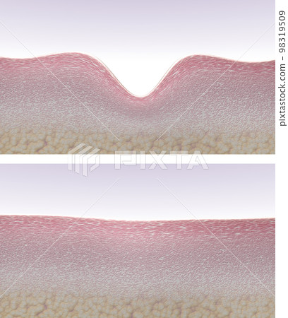 Skin tissues before and after anti-aging wrinkle reduction treatment. Wrinkle smoothing, skin renovation and collagen fibers regeneration process. 3d render before and after Skin tissues before and after anti-aging wrinkle reduction treatment. Wrinkle smoothing, skin renovation and collagen fibers regeneration process. 3d render before and after 98319509