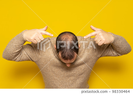 Human alopecia or hair loss. Middle-aged Latino man pointing to his head highlighting his incipient alopecia Human alopecia or hair loss. Middle-aged Latino man pointing to his head highlighting his incipient alopecia 98330464