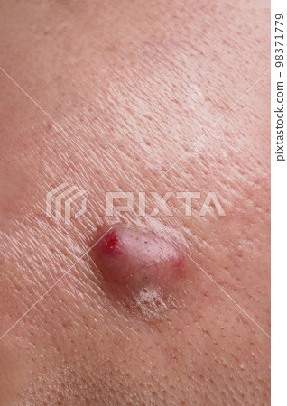 Bacterial skin infection. Big Acne Cyst Abscess or Ulcer Swollen area within face skin tissue. Containing accumulation of pus and blood. Macro shot of Acne or Dermatitis near mouth on face. Skincare. 98371779