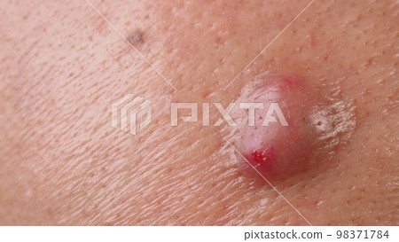 Bacterial skin infection. Big Acne Cyst Abscess or Ulcer Swollen area within face skin tissue. Containing accumulation of pus and blood. Macro shot of Acne or Dermatitis near mouth on face. Skincare. Bacterial skin infection. Big Acne Cyst Abscess or Ulcer Swollen area within face skin tissue. Containing accumulation of pus and blood. Macro shot of Acne or Dermatitis near mouth on face. Skincare. 98371784