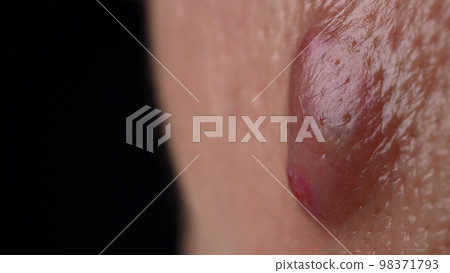 Bacterial skin infection. Big Acne Cyst Abscess or Ulcer Swollen area within face skin tissue. Containing accumulation of pus and blood. Macro shot of Acne or Dermatitis near mouth on face. Skincare. 98371793