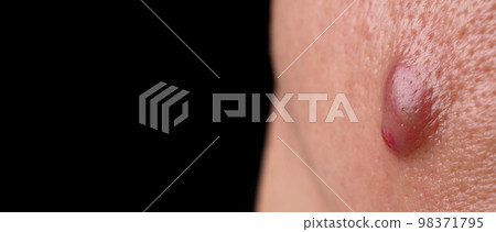 Bacterial skin infection. Big Acne Cyst Abscess or Ulcer Swollen area within face skin tissue. Containing accumulation of pus and blood. Macro shot of Acne or Dermatitis near mouth on face. Skincare. 98371795