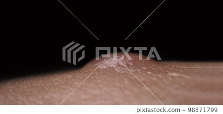 Bacterial skin infection. Big Acne Cyst Abscess or Ulcer Swollen area within face skin tissue. Containing accumulation of pus and blood. Macro shot of Acne or Dermatitis near mouth on face. Skincare. 98371799