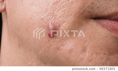 Bacterial skin infection. Big Acne Cyst Abscess or Ulcer Swollen area within face skin tissue. Containing accumulation of pus and blood. Macro shot of Acne or Dermatitis near mouth on face. Skincare. 98371805
