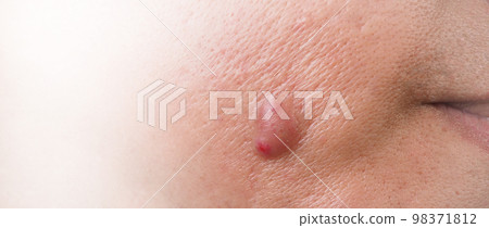 Bacterial skin infection. Big Acne Cyst Abscess or Ulcer Swollen area within face skin tissue. Containing accumulation of pus and blood. Macro shot of Acne or Dermatitis near mouth on face. Skincare. 98371812
