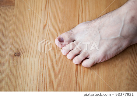 A toe is injured, a heavy object has fallen on the finger. Hematoma under the nail. A toe is injured, a heavy object has fallen on the finger. Hematoma under the nail. 98377921