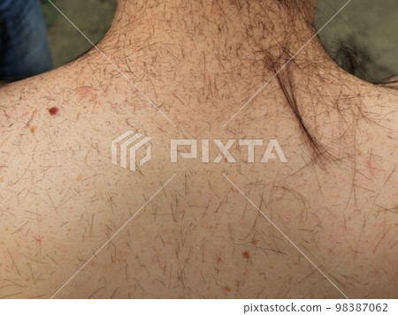 a human bare back strewn with cropped dark hair of various lengths, cutting the long hair of a man at home and a layer of cut hair on the upper back of the person a human bare back strewn with cropped dark hair of various lengths, cutting the long hair of a man at home and a layer of cut hair on the upper back of the person 98387062