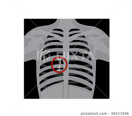 Accidental ingestion of foreign object 98413846