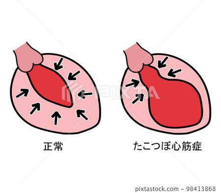 Takotsubo cardiomyopathy Takotsubo cardiomyopathy 98413868