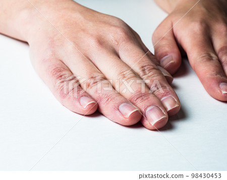 A woman's hand swollen with frostbite and chapped hands 98430453