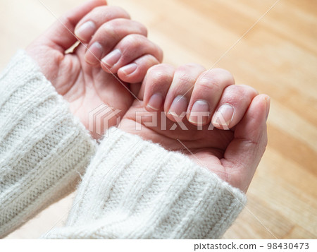 女人的手凍傷腫脹乾裂 98430473