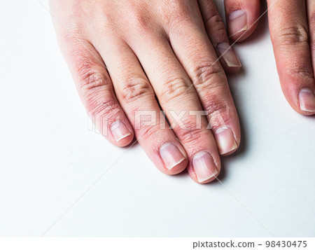 女人的手凍傷腫脹乾裂 女人的手凍傷腫脹乾裂 98430475