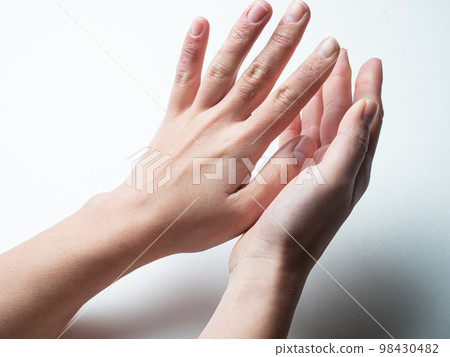 A woman's hand swollen with frostbite and chapped hands 98430482
