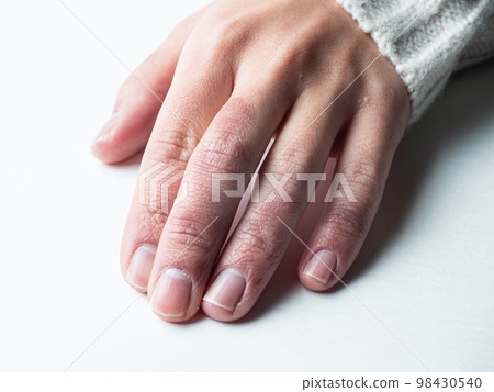 女人的手凍傷腫脹乾裂 女人的手凍傷腫脹乾裂 98430540