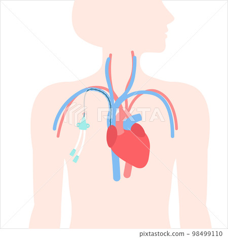 Tunneled central line venous catheter medical diagram Tunneled central line venous catheter medical diagram 98499110