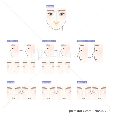 Rhinoplasty illustration set 98502722