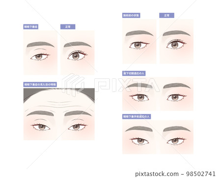 Eye surgery (ptosis) set 98502741