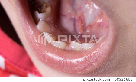 Crooked teeth in a child's mouth. The permanent tooth grows next to the milk tooth, close-up 98525693