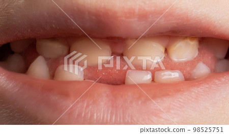 The smile of a child without one tooth in the jaw. Loss and removal of milk teeth in children, macro. Deciduous teeth The smile of a child without one tooth in the jaw. Loss and removal of milk teeth in children, macro. Deciduous teeth 98525751