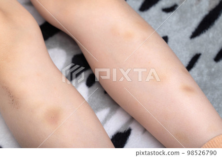 Spots, bruises on the legs of a child. The concept of injuries, lack of micro and macro elements, vitamins in the body. Spots, bruises on the legs of a child. The concept of injuries, lack of micro and macro elements, vitamins in the body. 98526790