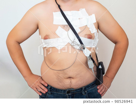 An obese man undergoes a Holter monitoring of the heart. A modern method for studying the heart in caodiology. Arrhythmia and ischemic disease. Medic 98526941
