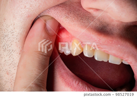 Red and swollen gums in a man. Gum disease gingivitis, flux and inflammation. Macro 98527019