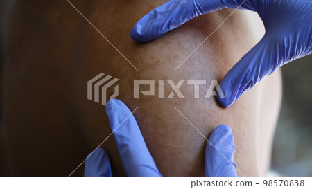 Doctor examines skin disease of his patient close-up. Doctor examines skin disease of his patient close-up. 98570838