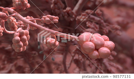 The bronchial occlusion causes air to be sucked from distal lung tissue and therefore this area shrinks and collapses The bronchial occlusion causes air to be sucked from distal lung tissue and therefore this area shrinks and collapses 98577131