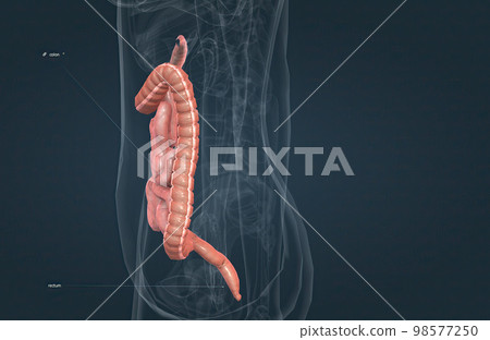The small bowel connects to the large bowel, also called the large intestine or colon. The small bowel connects to the large bowel, also called the large intestine or colon. 98577250