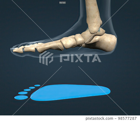 Flat feet is a common condition in which the arches on the inside of the feet flatten when pressure is applied to them. Flat feet is a common condition in which the arches on the inside of the feet flatten when pressure is applied to them. 98577287