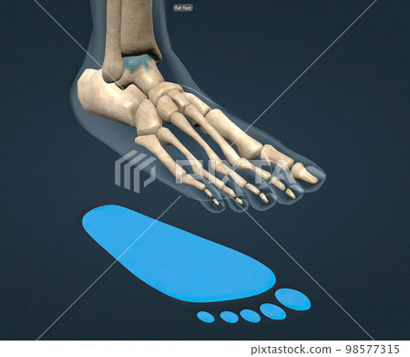 Flat feet is a common condition in which the arches on the inside of the feet flatten when pressure is applied to them. Flat feet is a common condition in which the arches on the inside of the feet flatten when pressure is applied to them. 98577315
