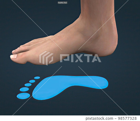 Healthy foot and blue footprint - Stock Illustration [98577328] - PIXTA