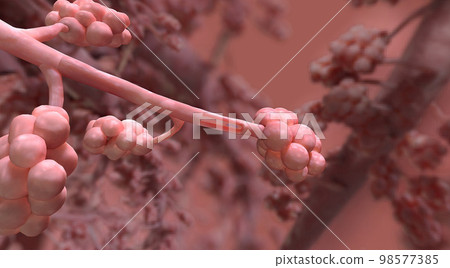 The bronchial occlusion causes air to be sucked from distal lung tissue and therefore this area shrinks and collapses 98577385
