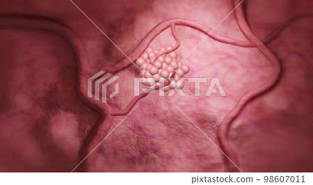 Lung cancer is caused by uncontrolled growth of harmful cells in our lungs. 98607011